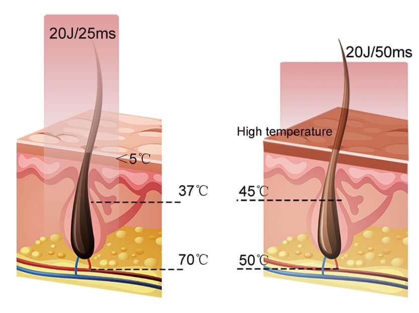 808nm laser hair removal technology advancements